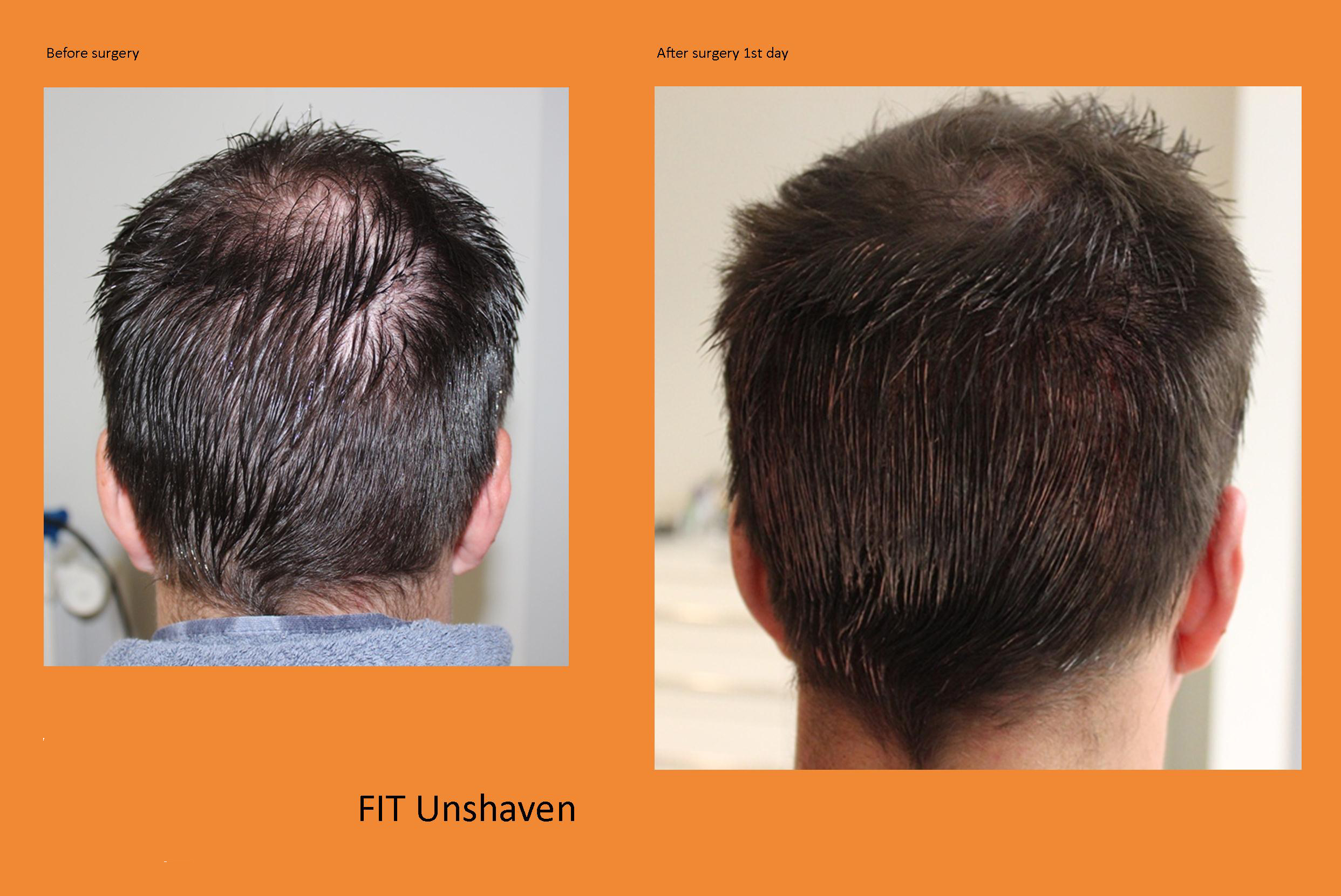 U-FUE Hairtransplant Extraction without shaving